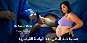 عملية شد البطن بعد الولادة القيصرية