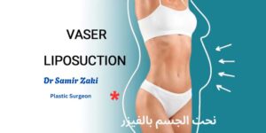 نحت الجسم بالفيزر